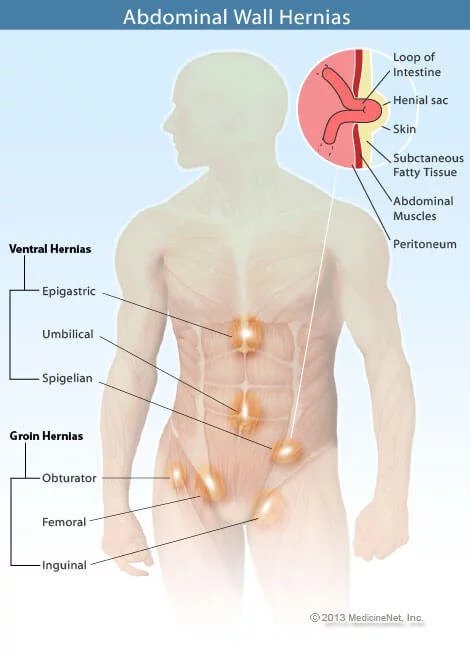 cure hernia